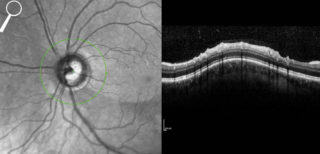OCT SNK-Auge-300x144 in SPECTRALIS OCT