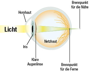 Alterssichtigkeit in Refraktive Chirurgie