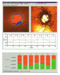 Uebersicht Astigmatismus Rectus-300x240 in Keratograph