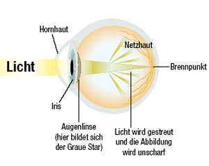 Grauer-star in Refraktive Chirurgie